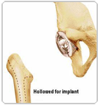 Hollowed Lower Bone for the Implant - Dr Niraj Vora